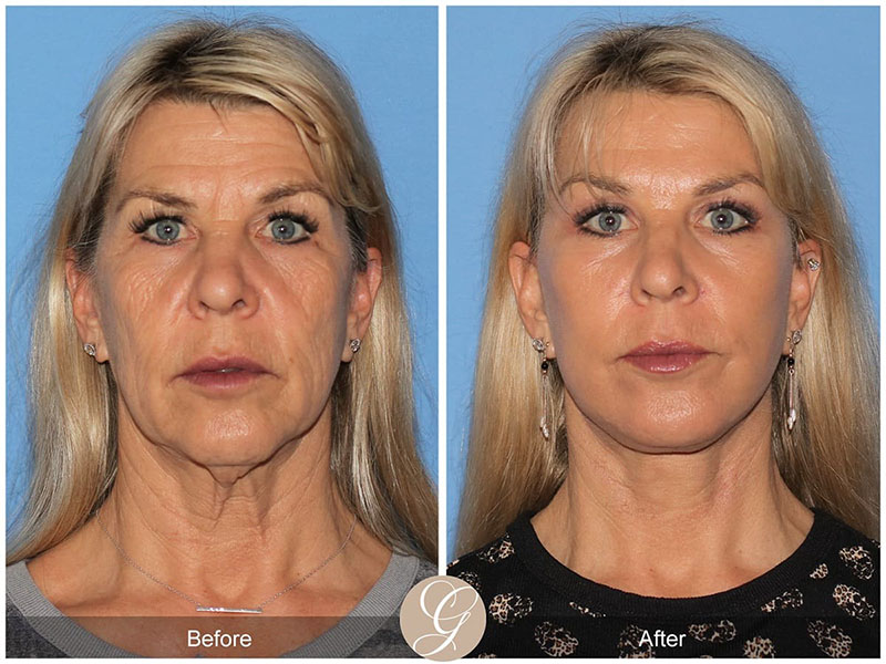 vertical facelift before and after patient 02