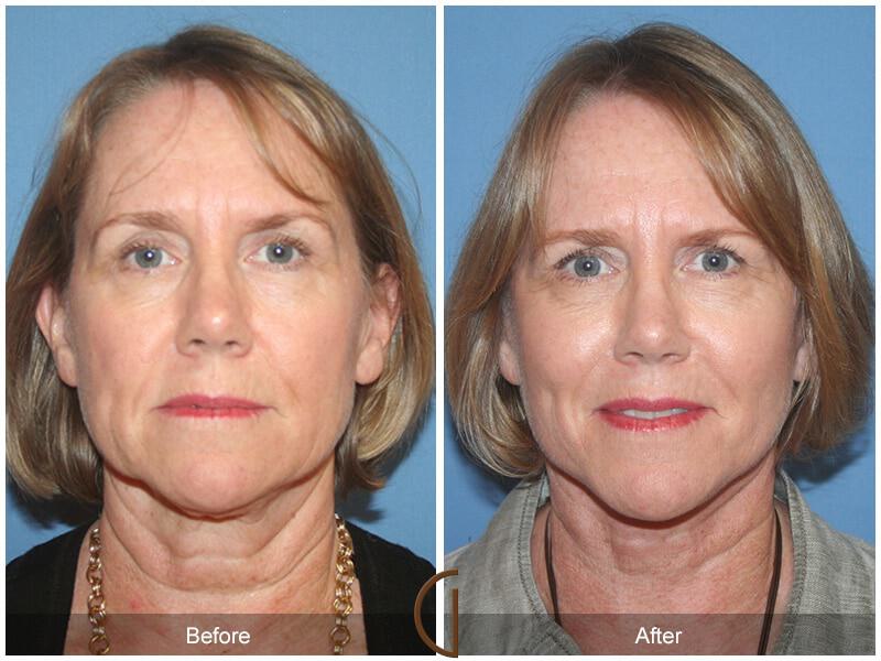Eyelid Lift Before & After Photo