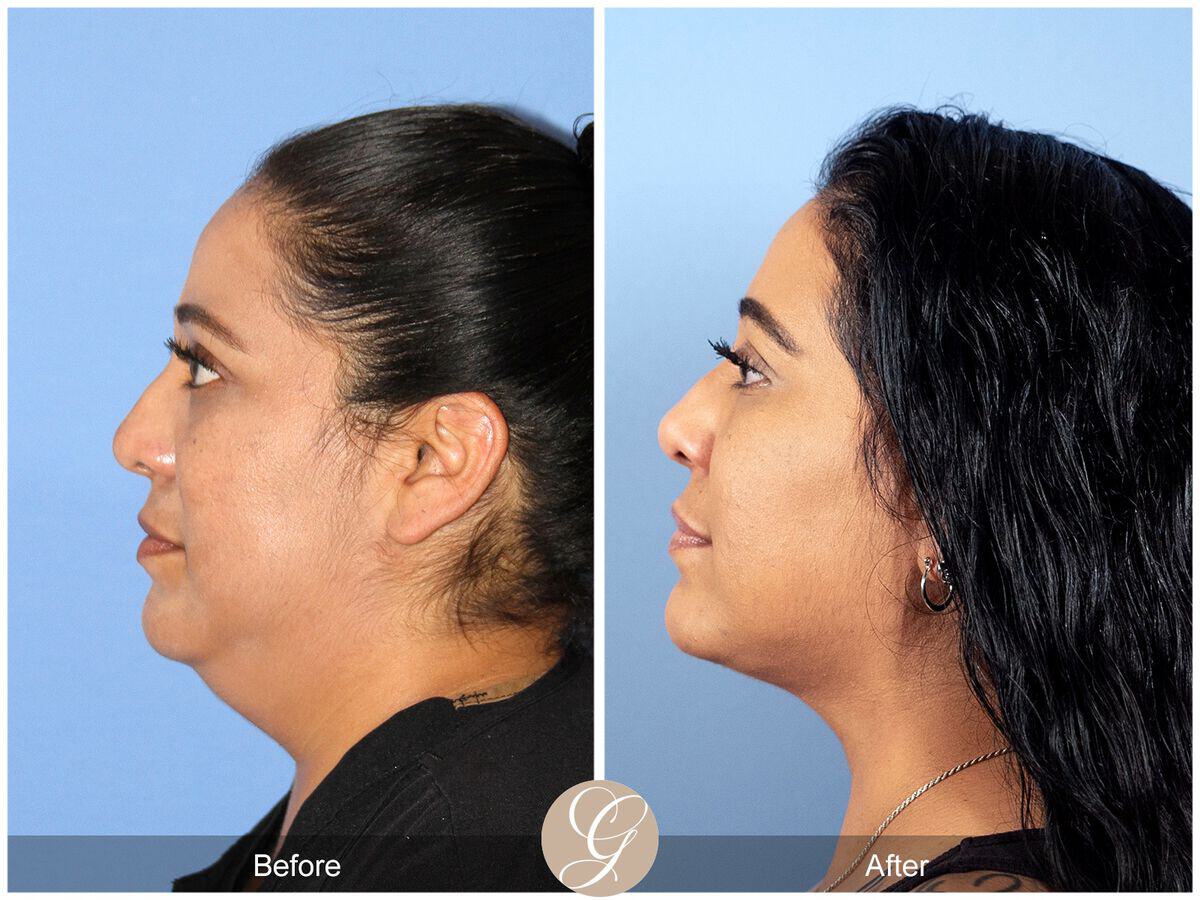 Neck Liposuction Before & After Photo