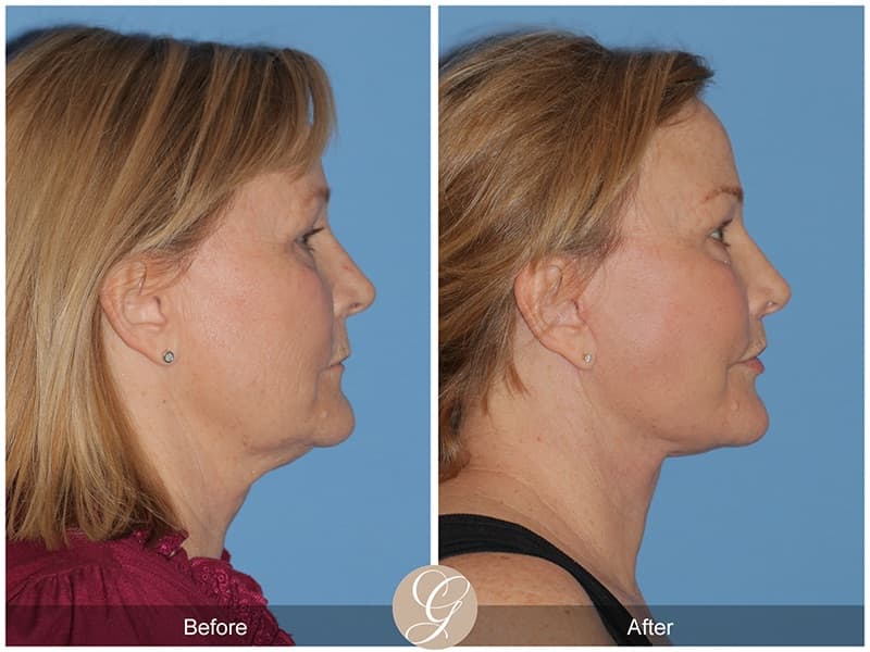 Deep Plane Facelifts Before & After Photo