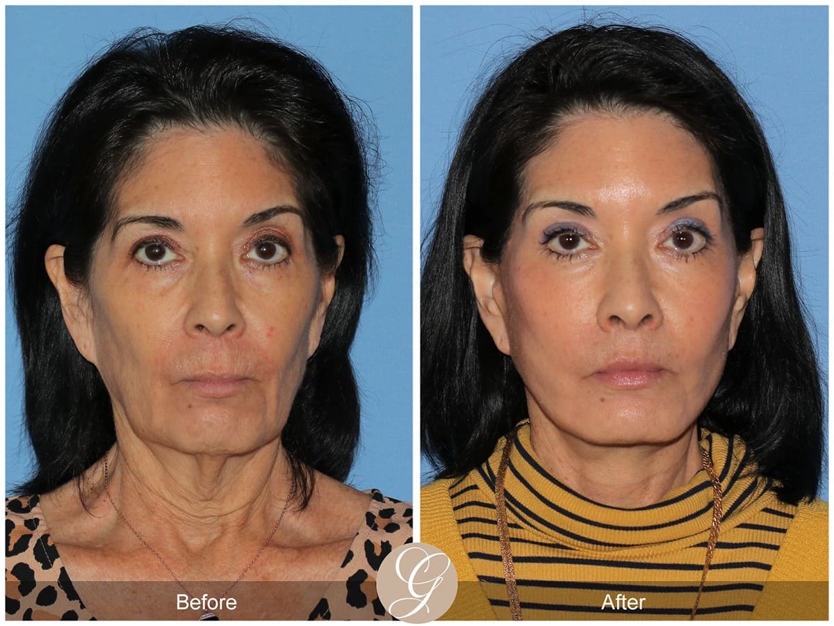 Deep Plane Facelifts Before & After Photo
