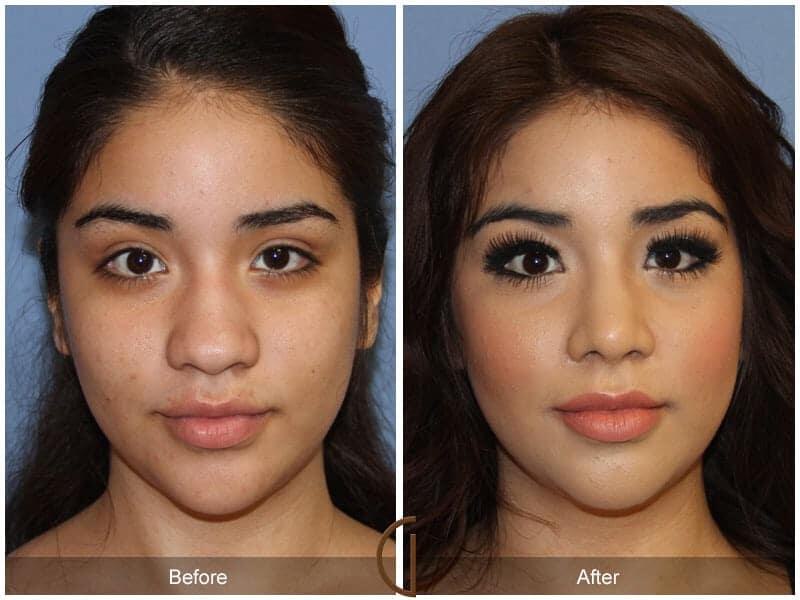 Ethnic Rhinoplasty patient newport beach Before and after