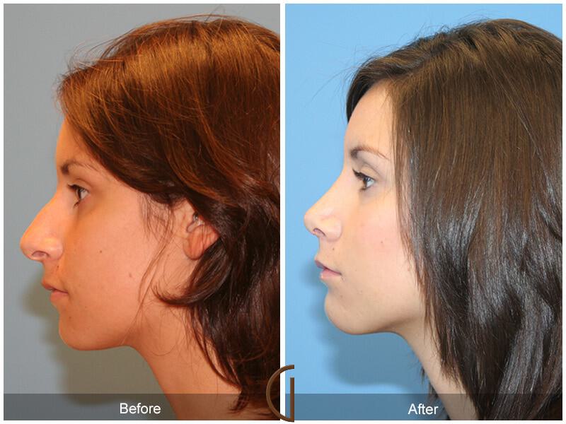 Female Rhinoplasty patient newport beach Before and After
