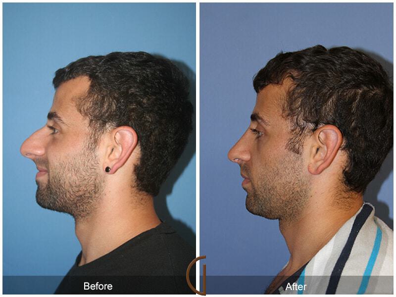 Male Rhinoplasty patient newport beach before and after photos