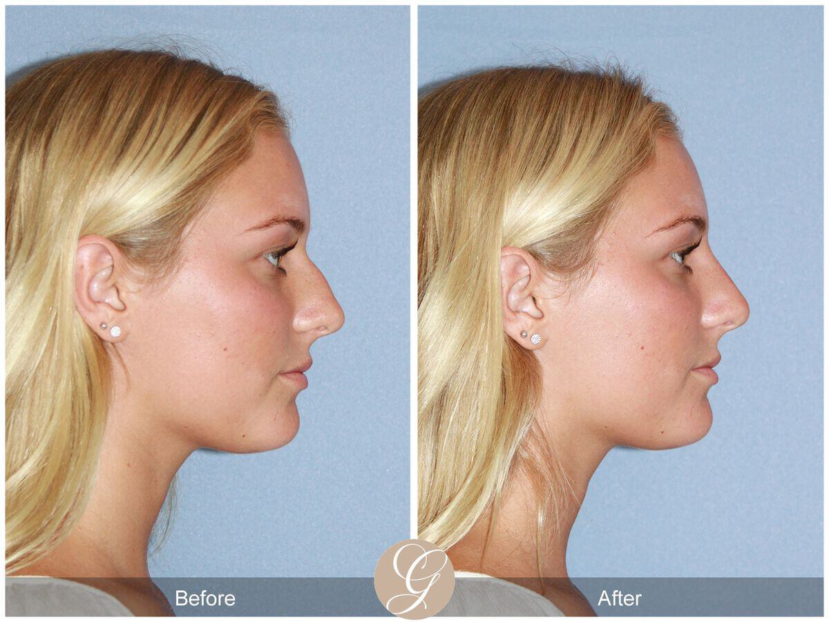 Non-surgical Rhinoplasty patient newport beach before and after