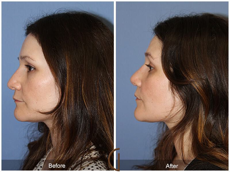 Revision Rhinoplasty patient newport beach before and after