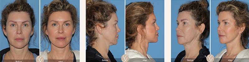 The Modern Lift: Facelifts That Look Effortlessly You