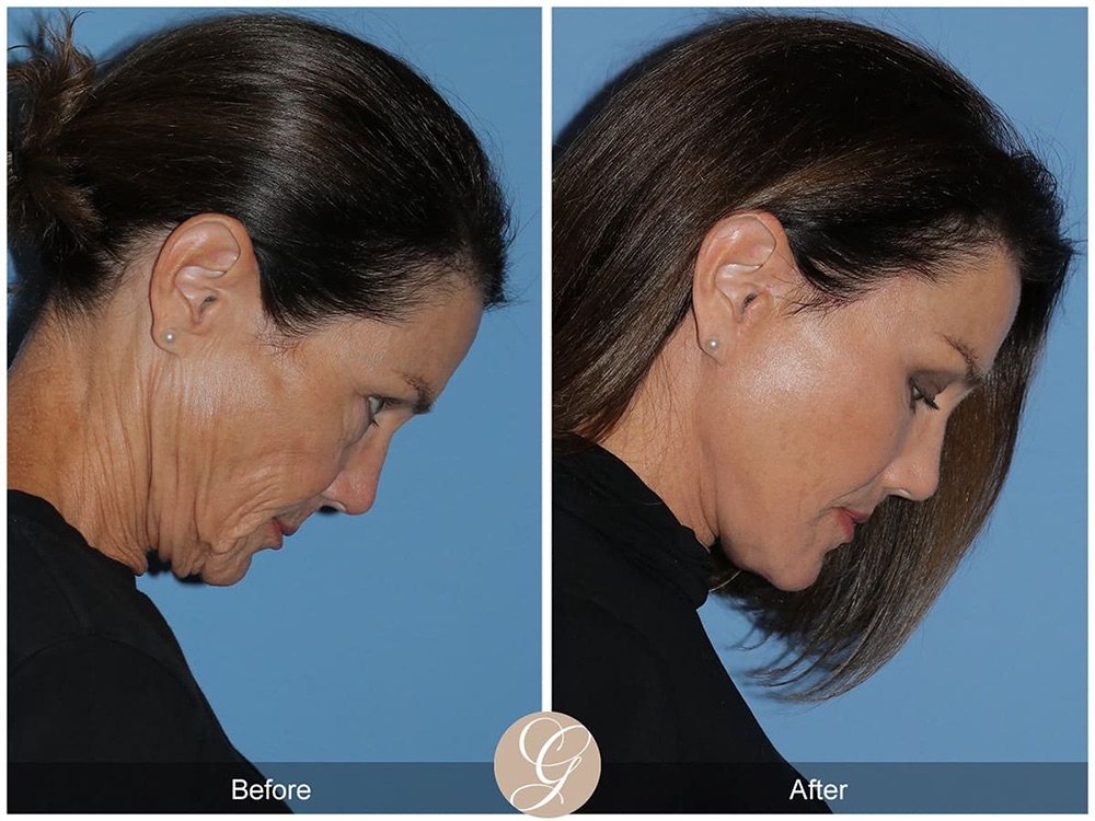 facelift before and after