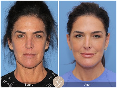 Evolution of Deep Plane Facelift