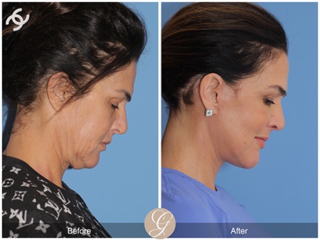 Evolution of Deep Plane Facelift