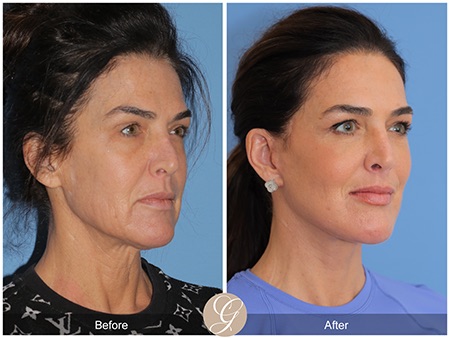 Evolution of Deep Plane Facelift