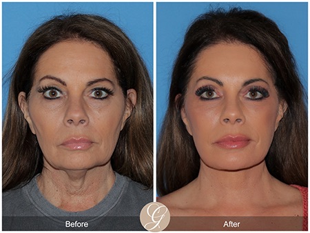 Evolution of Deep Plane Facelift