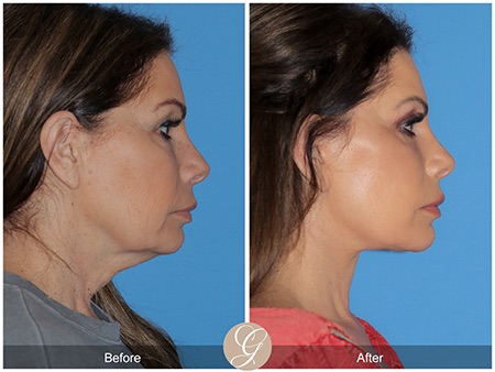 Evolution of Deep Plane Facelift