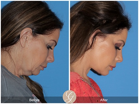 Evolution of Deep Plane Facelift