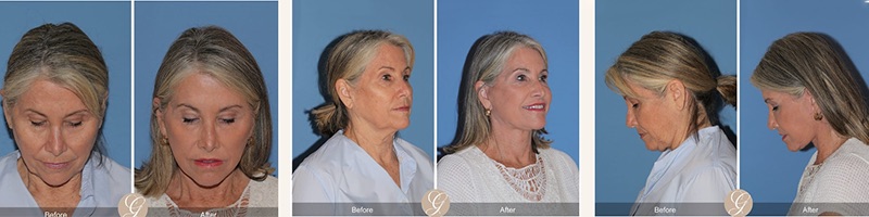 The Modern Lift: Facelifts That Look Effortlessly You