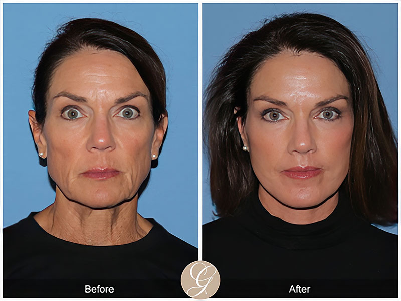 ozempic patient model before and after
