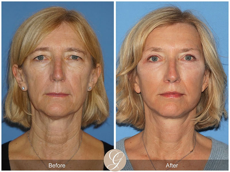 vertical facelift before and after patient 01