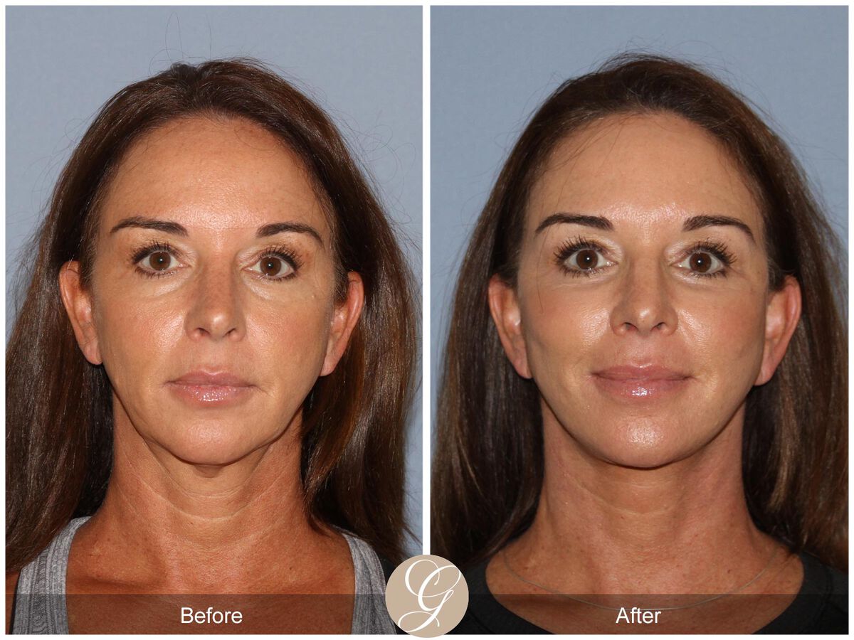 Facelift Before and After Woman in her 40s Newport Beach