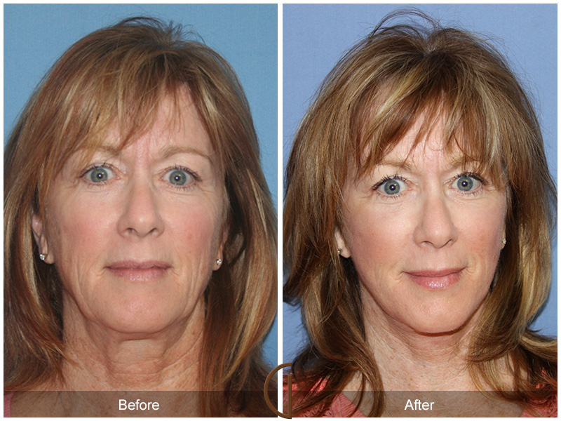 newport beach Facelift patient in her 50s Before and After