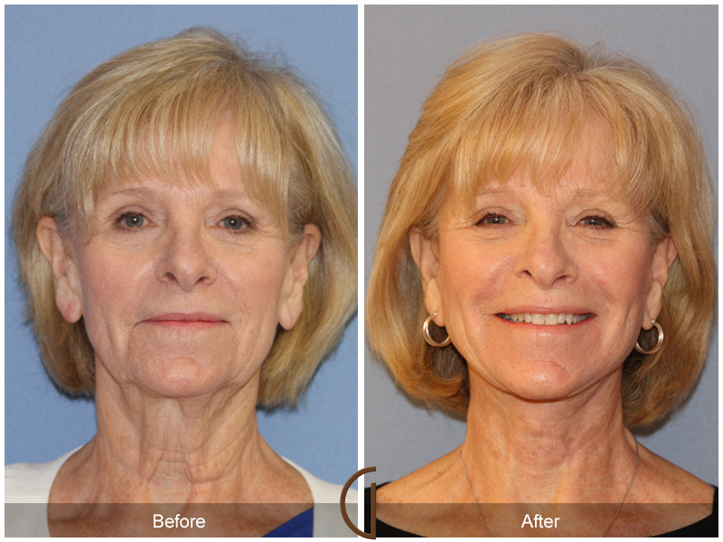 Women in 60s before and after Facelift newport beach