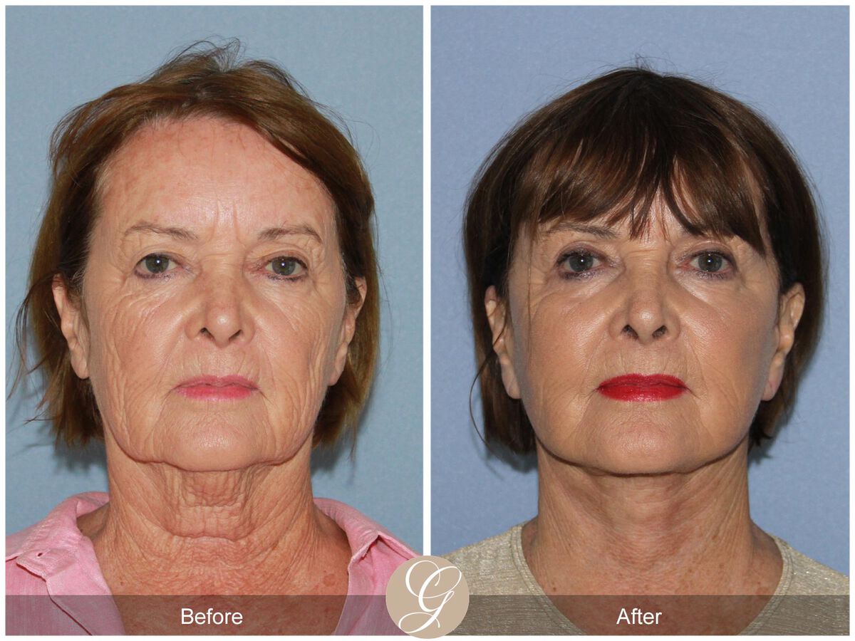 Women in 70s before and after Facelift newport beach