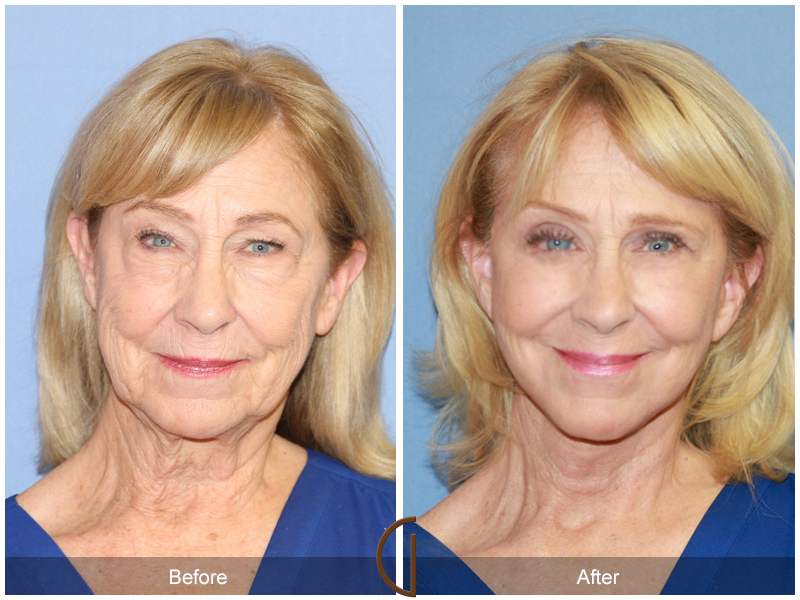Woman Before and After Facelift in Newport Beach