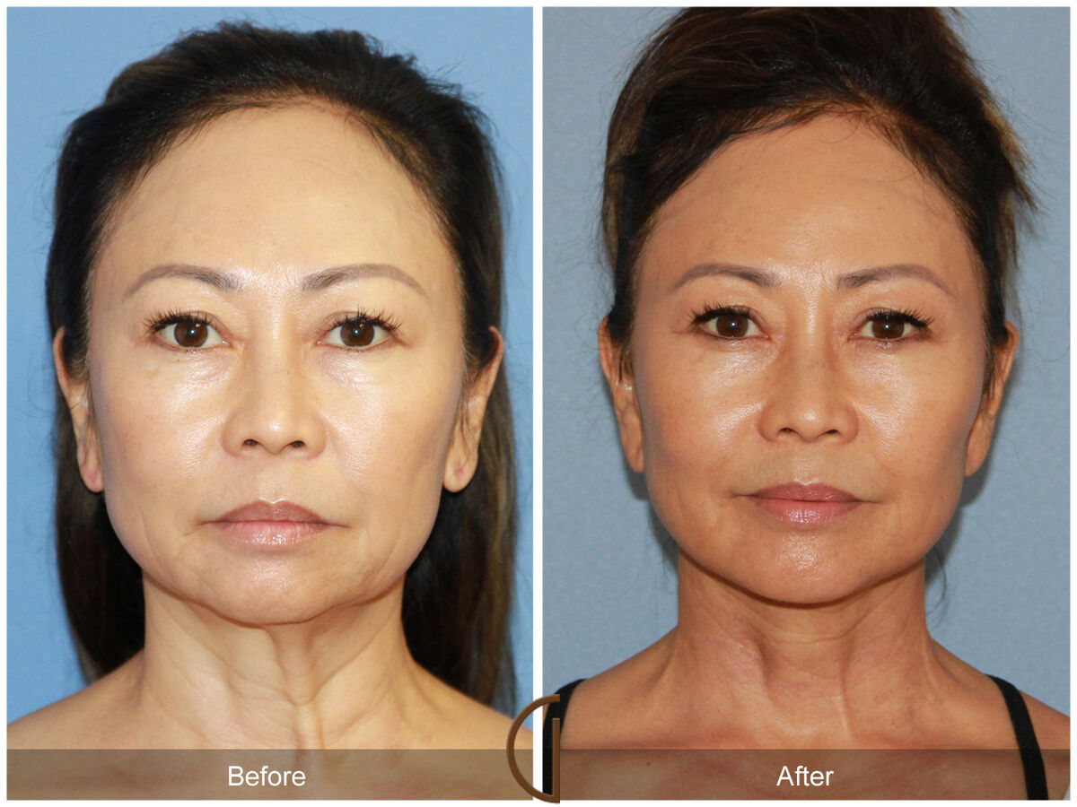 newport beach Ethnic Facelift patient before and after