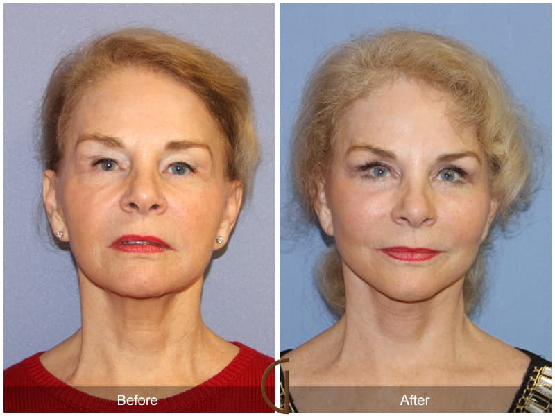 newport beach revision facelift patient before and after