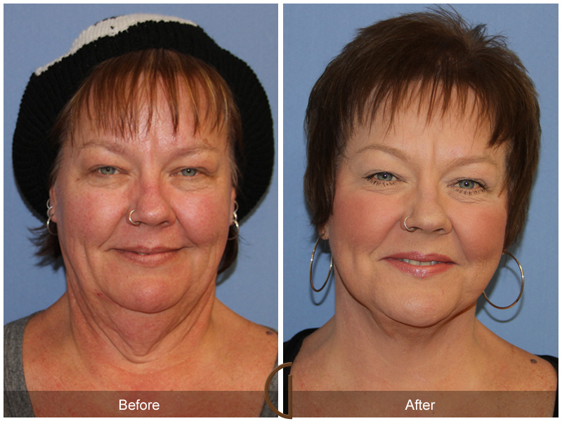 newport beach after weight loss facelift patient before and after