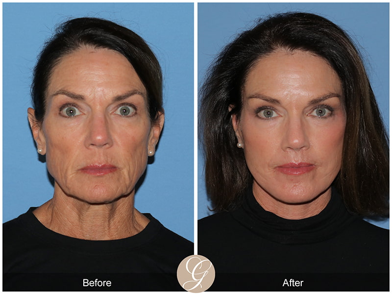 Real Deep Plane Facelift Before and After Photo 1 - Newport Beach, CA