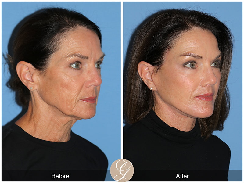 Real Deep Plane Facelift Before and After Photo 2 - Newport Beach, CA