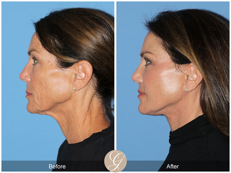 Real Deep Plane Facelift Before and After Photo 3 - Newport Beach, CA