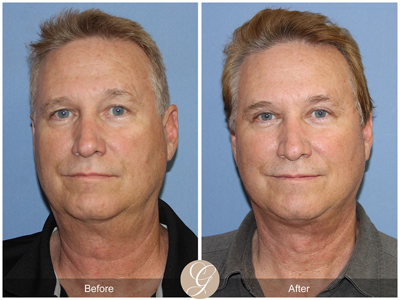 Real Male Facelift Before and After Photo 1 - Newport Beach, CA