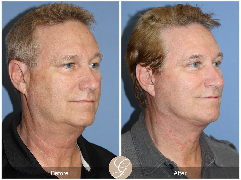 Real Male Facelift Before and After Photo 2 - Newport Beach, CA