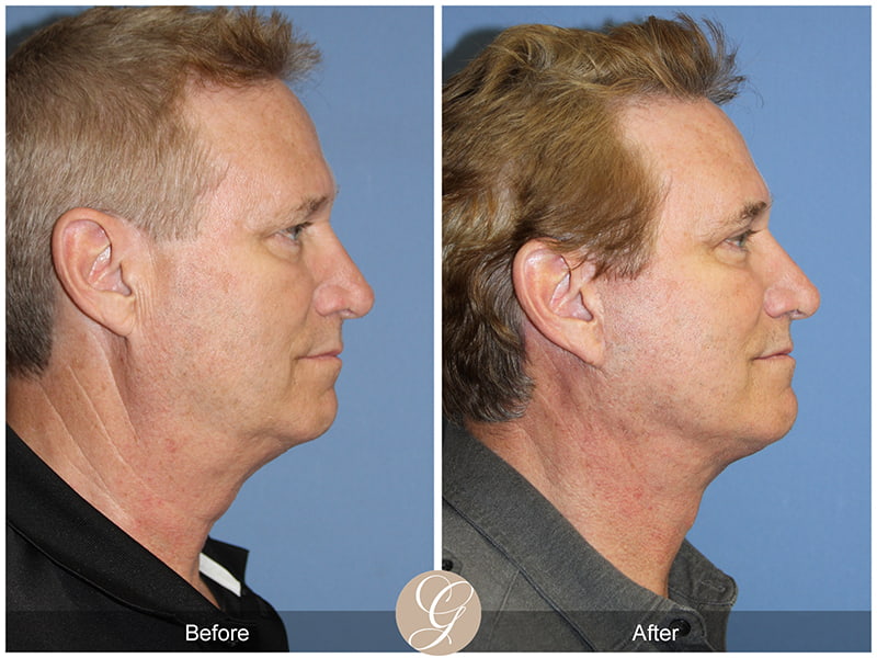 Real Male Facelift Before and After Photo 3 - Newport Beach, CA
