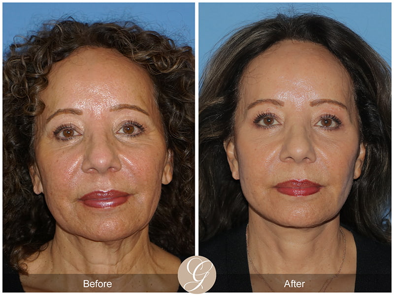Real SMAS Facelift Before and After Photo 1 - Newport Beach, CA