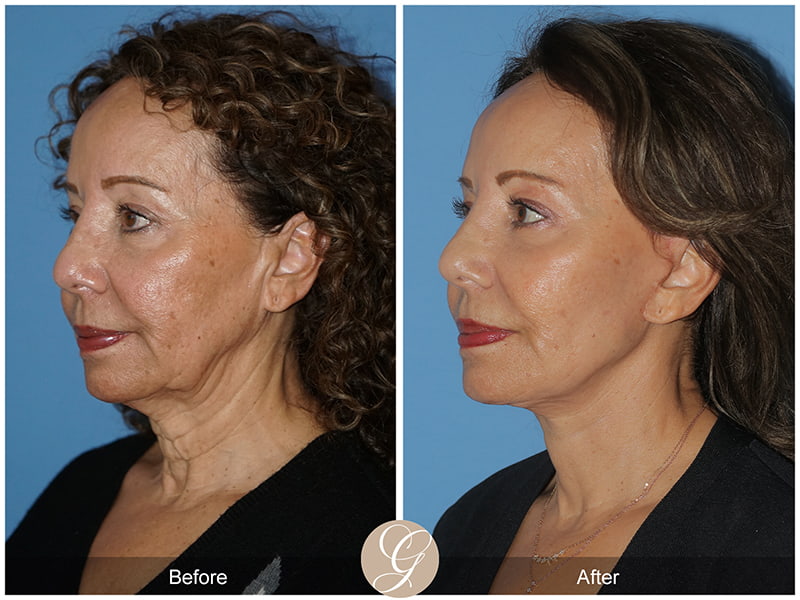 Real SMAS Facelift Before and After Photo 2 - Newport Beach, CA