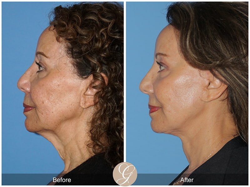 Real SMAS Facelift Before and After Photo 3 - Newport Beach, CA