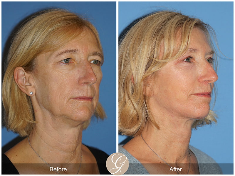 Real Vertical Facelift Before and After Photo 2 - Newport Beach, CA