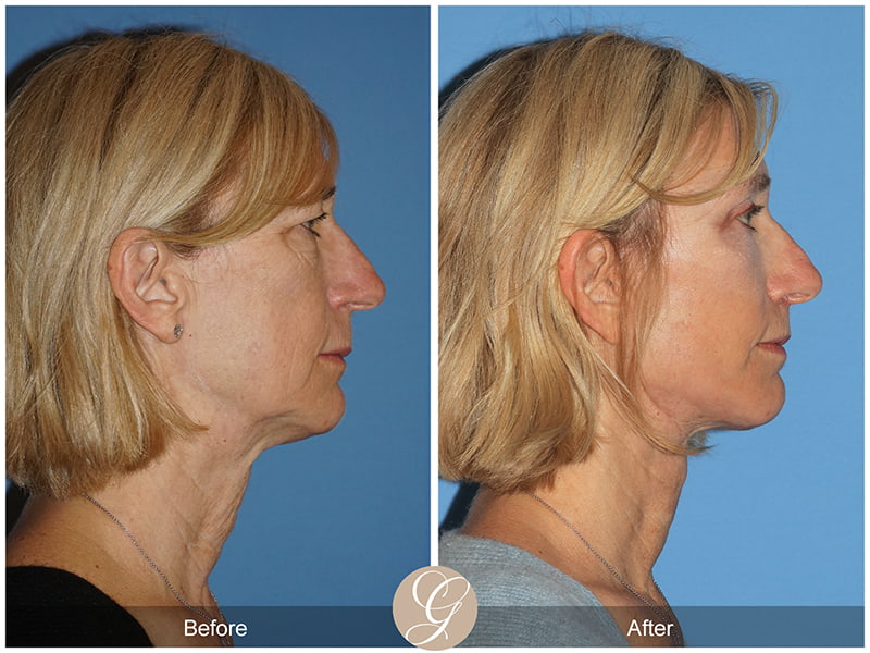 Real Vertical Facelift Before and After Photo 3 - Newport Beach, CA
