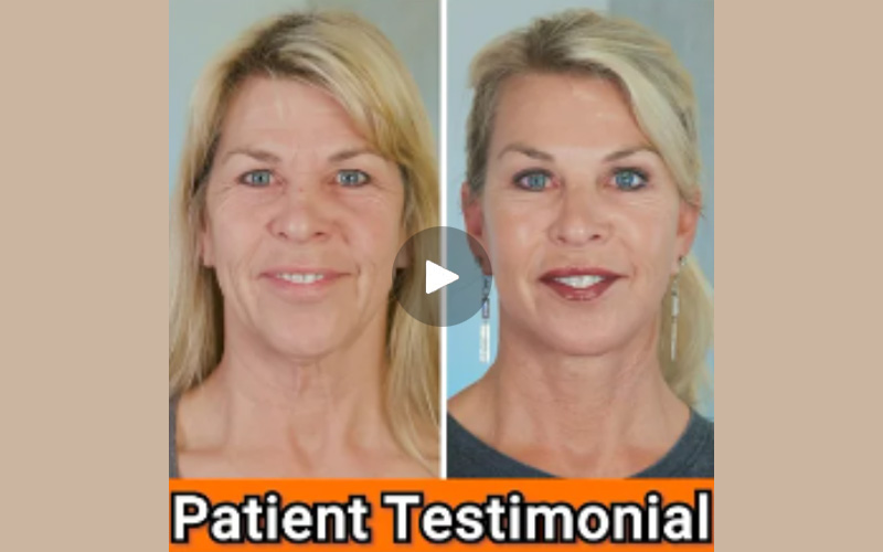 Vertical Facelift Video Review