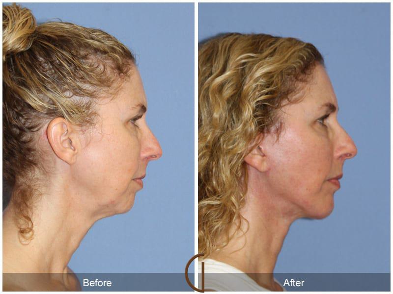 Chin Augmentation Before & After Photo