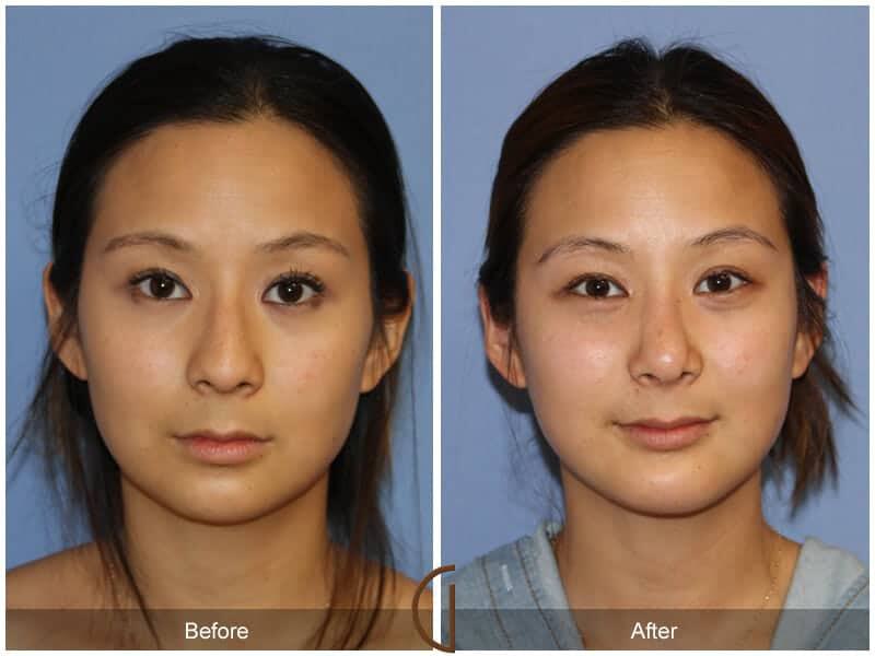 Chin Augmentation Before & After Photo