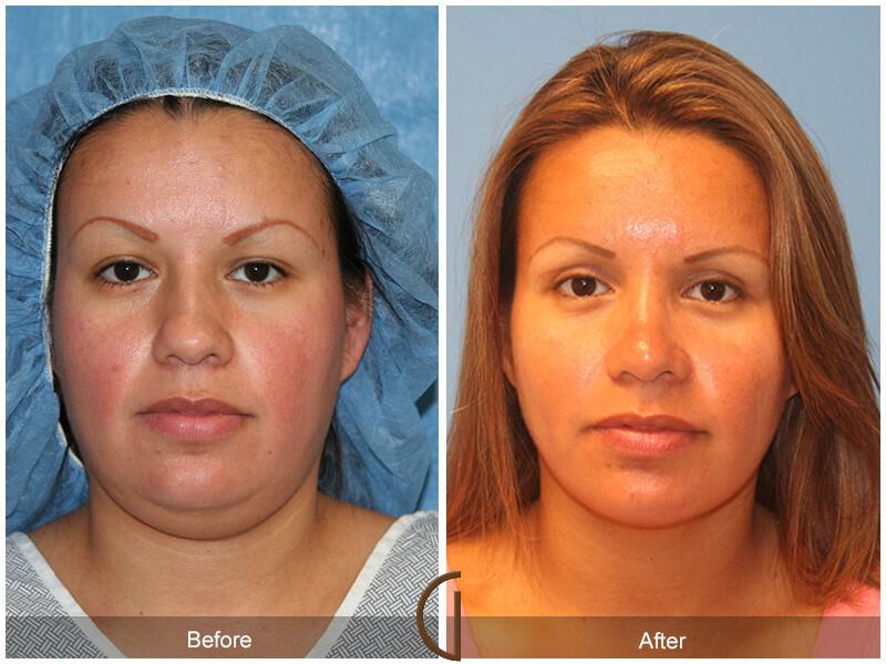 Chin Augmentation Before & After Photo