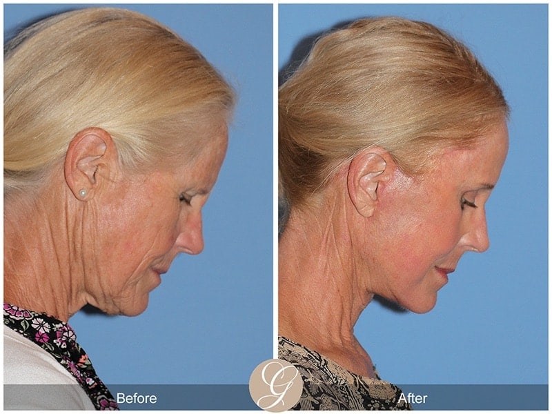 Deep Plane Facelift Before & After Photo