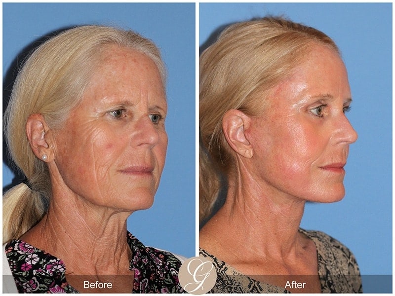 Deep Plane Facelift Before & After Photo