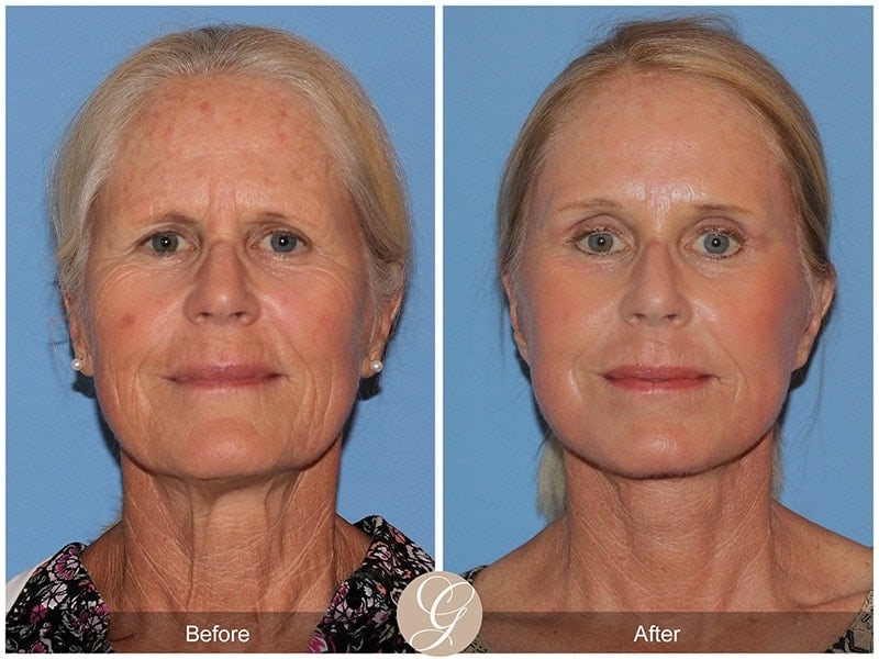 Deep Plane Facelift Before & After Photo