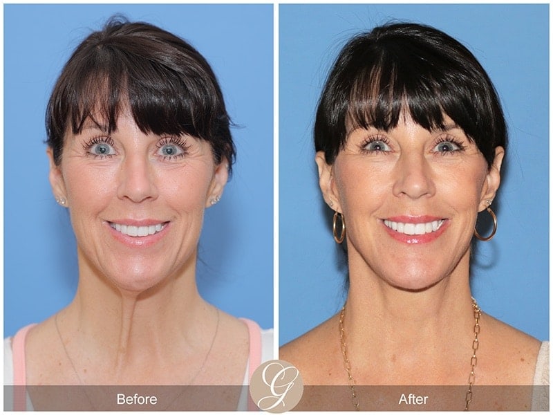 Deep Plane Facelift Before & After Photo