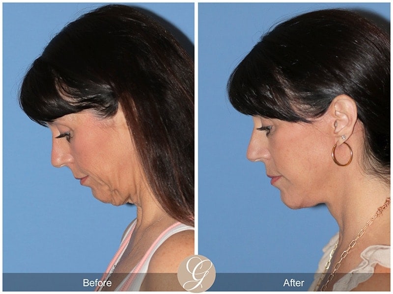 Deep Plane Facelift Before & After Photo