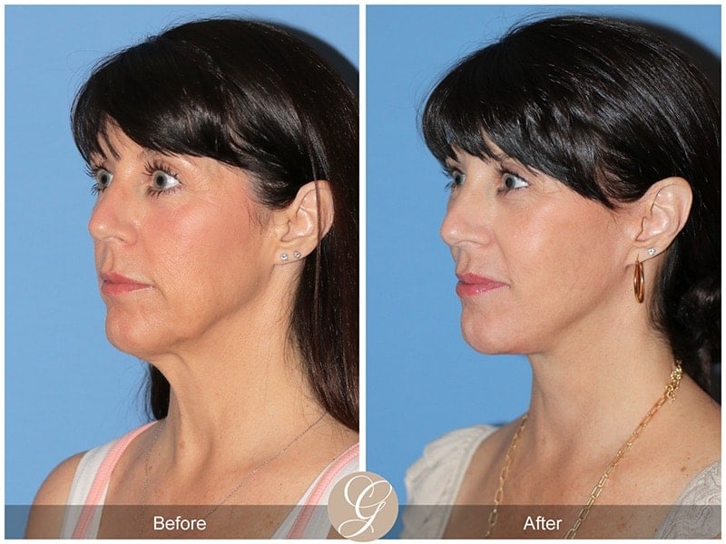 Deep Plane Facelift Before & After Photo